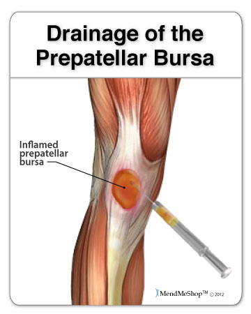 Bursectomy knee complications