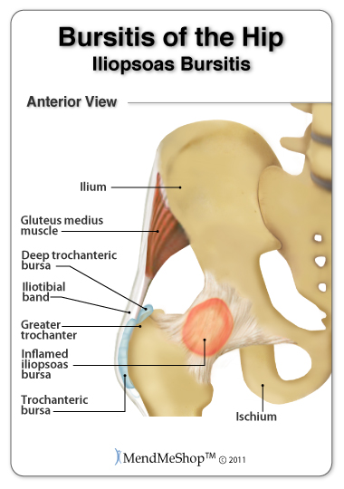 iliopsoas bursa in the hip