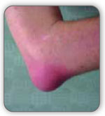 Elbow Bursitis pain can be caused by infection, or septic bursitis