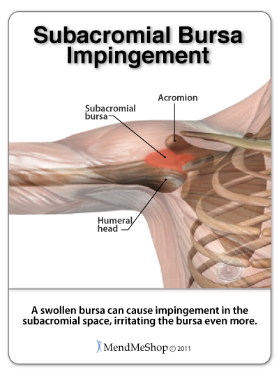 shoulder bursitis recovery time miért fáj az alkar ízületei