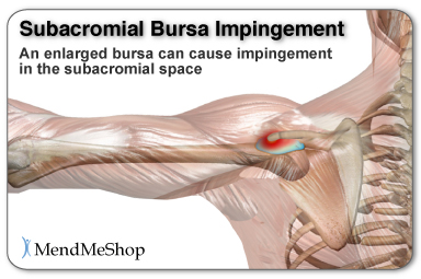 Subacromial and subdeltoid bursae impingement in the shoulder