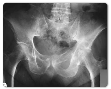 pelis hip x-ray